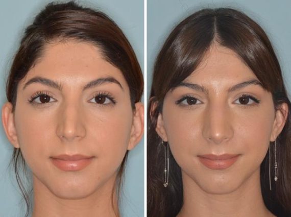 Rhinoplasty Before and After Photos in Miami, FL, Patient 401