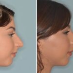 Rhinoplasty Before and After Photos in Miami, FL, Patient 401