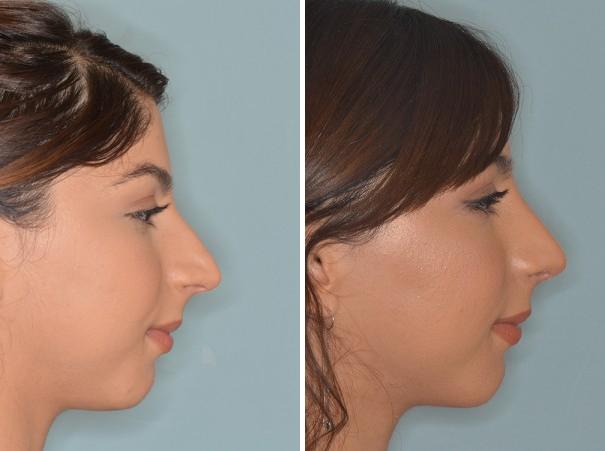 Rhinoplasty Before and After Photos in Miami, FL, Patient 401