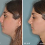 Rhinoplasty Before and After Photos in Miami, FL, Patient 191