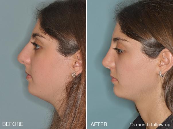Rhinoplasty Before and After Photos in Miami, FL, Patient 191
