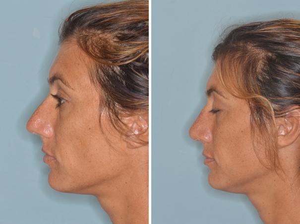 Rhinoplasty Before and After Photos in Miami, FL, Patient 408
