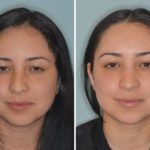 Rhinoplasty Before and After Photos in Miami, FL, Patient 421