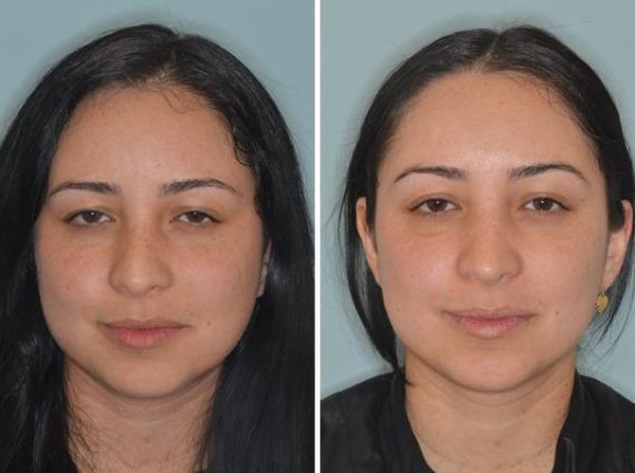 Rhinoplasty Before and After Photos in Miami, FL, Patient 421