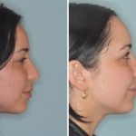 Rhinoplasty Before and After Photos in Miami, FL, Patient 421