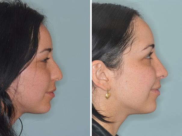 Rhinoplasty Before and After Photos in Miami, FL, Patient 421