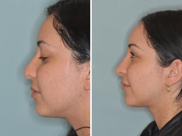 Rhinoplasty Before and After Photos in Miami, FL, Patient 421