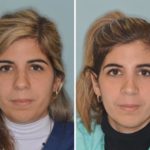 Rhinoplasty Before and After Photos in Miami, FL, Patient 439