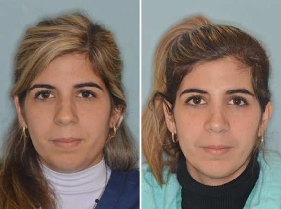Rhinoplasty Before and After Photos in Miami, FL, Patient 439