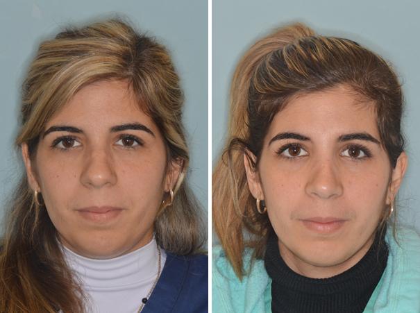 Rhinoplasty Before and After Photos in Miami, FL, Patient 439