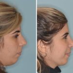 Rhinoplasty Before and After Photos in Miami, FL, Patient 439