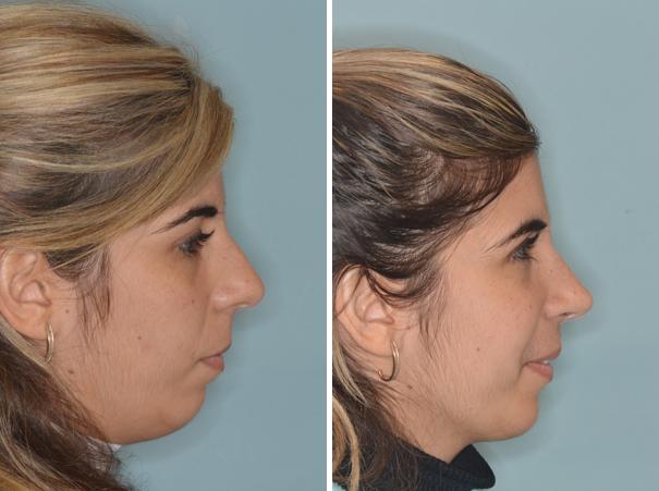 Rhinoplasty Before and After Photos in Miami, FL, Patient 439