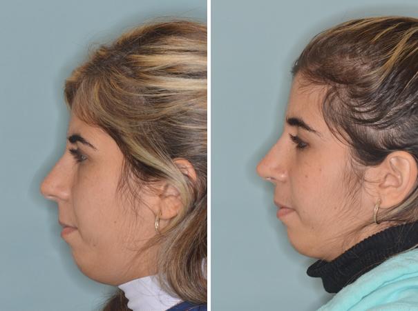 Rhinoplasty Before and After Photos in Miami, FL, Patient 439