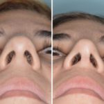 Rhinoplasty Before and After Photos in Miami, FL, Patient 439