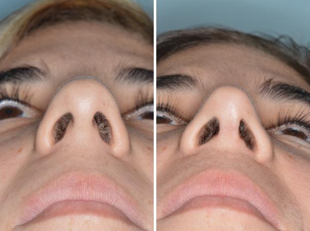 Rhinoplasty Before and After Photos in Miami, FL, Patient 439