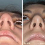 Rhinoplasty Before and After Photos in Miami, FL, Patient 191