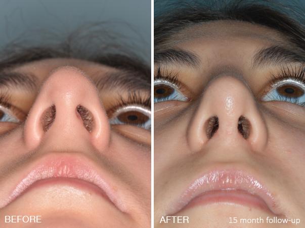 Rhinoplasty Before and After Photos in Miami, FL, Patient 191