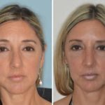 Rhinoplasty Before and After Photos in Miami, FL, Patient 444