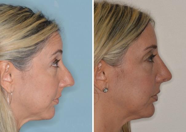 Rhinoplasty Before and After Photos in Miami, FL, Patient 444