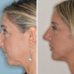 Rhinoplasty Before and After Photos in Miami, FL, Patient 444