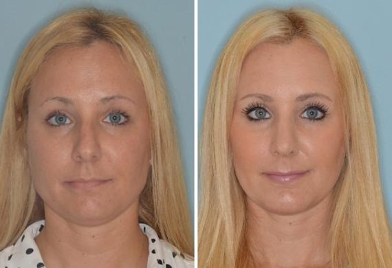 Rhinoplasty Before and After Photos in Miami, FL, Patient 460