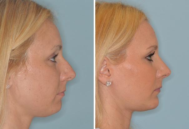 Rhinoplasty Before and After Photos in Miami, FL, Patient 460