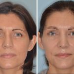 Rhinoplasty Before and After Photos in Miami, FL, Patient 472