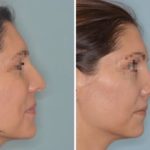 Rhinoplasty Before and After Photos in Miami, FL, Patient 472