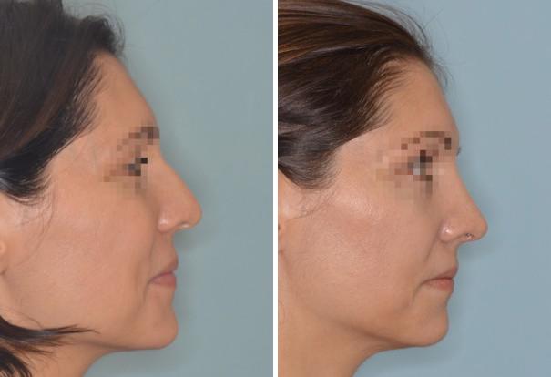 Rhinoplasty Before and After Photos in Miami, FL, Patient 472