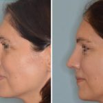 Rhinoplasty Before and After Photos in Miami, FL, Patient 472