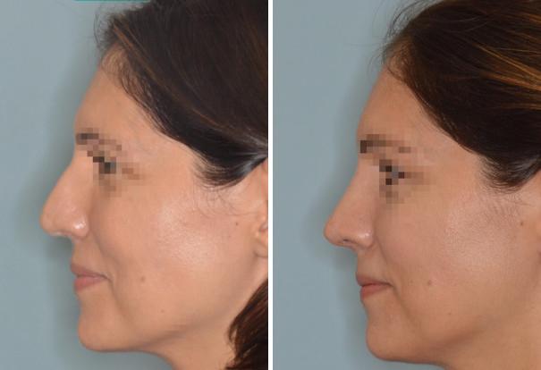 Rhinoplasty Before and After Photos in Miami, FL, Patient 472