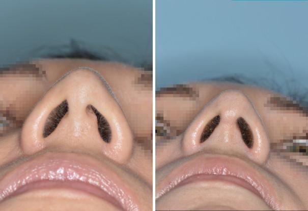 Rhinoplasty Before and After Photos in Miami, FL, Patient 472