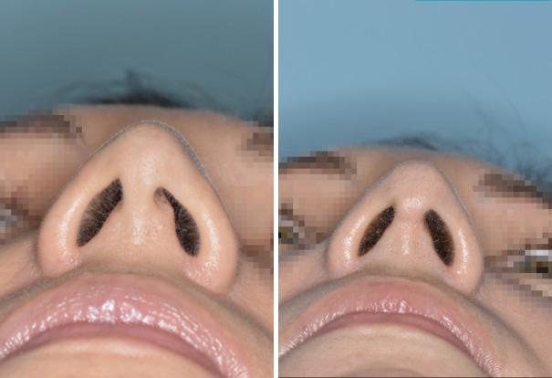 Rhinoplasty Before and After Photos in Miami, FL, Patient 472