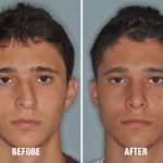 Rhinoplasty Before and After Photos in Miami, FL, Patient 204