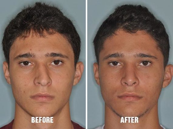 Rhinoplasty Before and After Photos in Miami, FL, Patient 204