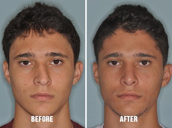 Rhinoplasty Before and After Photos in Miami, FL, Patient 204