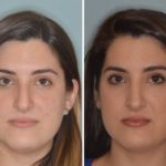 Rhinoplasty Before and After Photos in Miami, FL, Patient 477