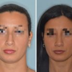 Rhinoplasty Before and After Photos in Miami, FL, Patient 489