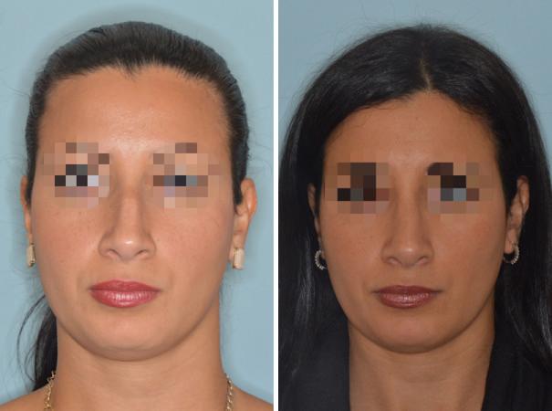 Rhinoplasty Before and After Photos in Miami, FL, Patient 489