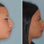 Rhinoplasty Before and After Photos in Miami, FL, Patient 489