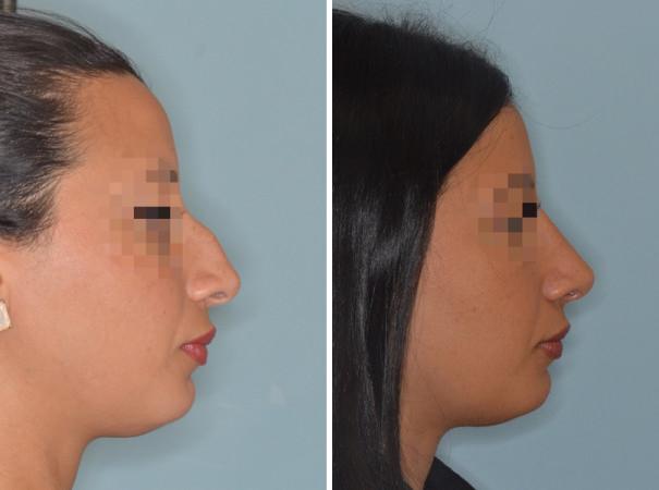 Rhinoplasty Before and After Photos in Miami, FL, Patient 489