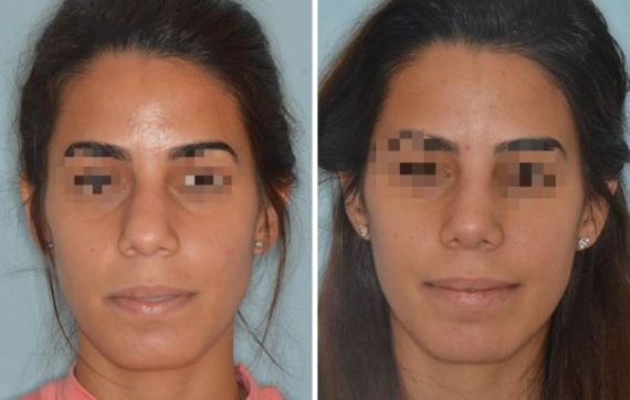 Rhinoplasty Before and After Photos in Miami, FL, Patient 492