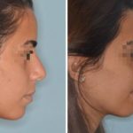 Rhinoplasty Before and After Photos in Miami, FL, Patient 492