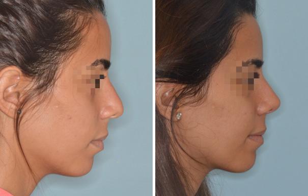 Rhinoplasty Before and After Photos in Miami, FL, Patient 492