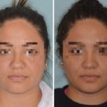 Rhinoplasty Before and After Photos in Miami, FL, Patient 505