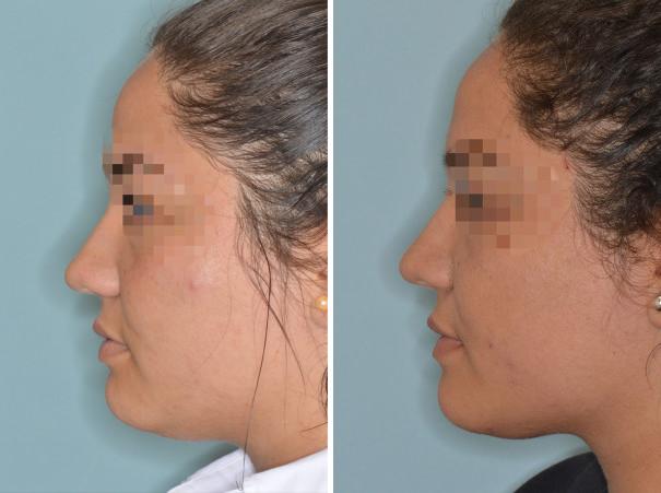 Rhinoplasty Before and After Photos in Miami, FL, Patient 505