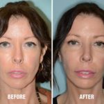 Chin Augmentation Before and After Photos in Miami, FL, Patient 2590