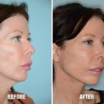 Chin Augmentation Before and After Photos in Miami, FL, Patient 2590