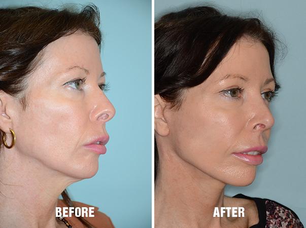 Chin Augmentation Before and After Photos in Miami, FL, Patient 2590