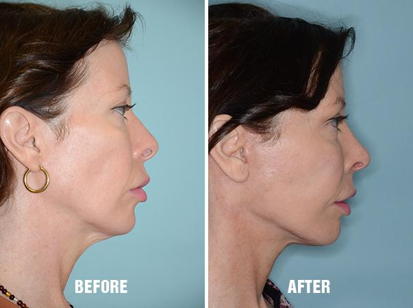 Chin Augmentation Before and After Photos in Miami, FL, Patient 2590